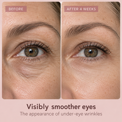 Dissolving Hyaluronic Microneedle Under-Eye Patches