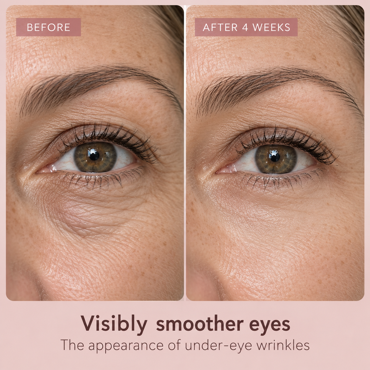 Dissolving Hyaluronic Microneedle Under-Eye Patches